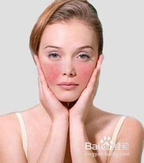 皮肤为什么会出现红血丝呢?