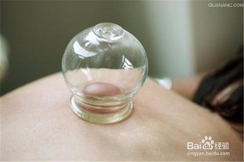 如何正确拔火罐