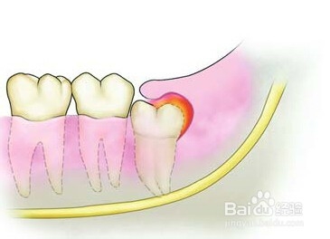 长智齿龈肿痛怎么办
