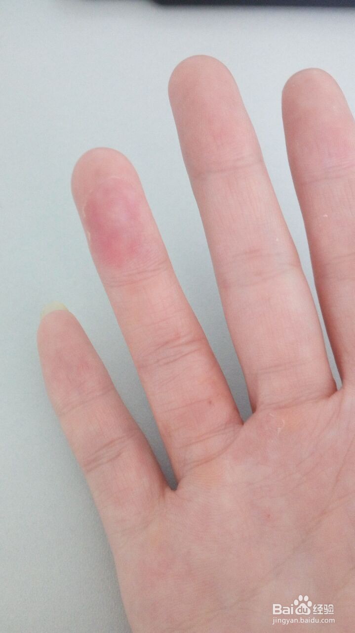 手指小水泡的治疗过程（真实经验）