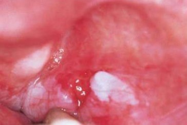 诱发口腔扁平苔藓的八大原因