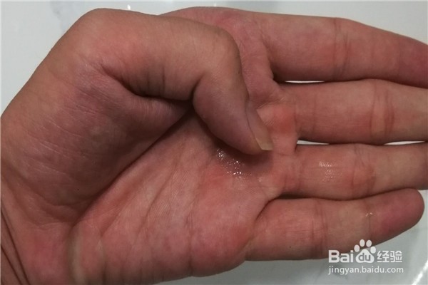 三秒胶弄到手上怎么去除