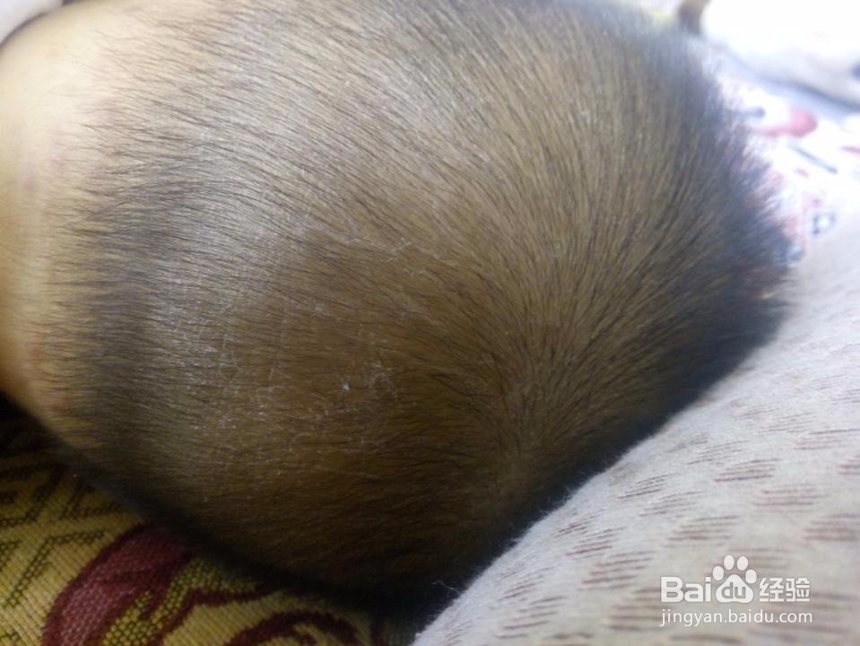 夏天怎么去痱子