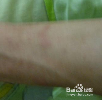 黑斑要怎么去除