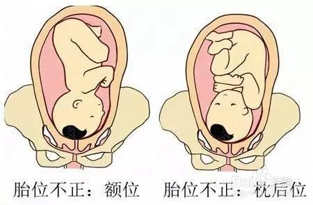 > 孕中 1 睡覺時適當坐臥位,科學安排工作生活時間,有助於糾正胎位