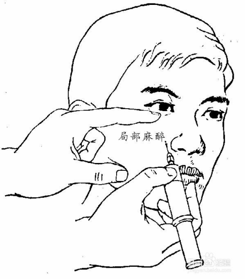 疤痕很影响形象,手术切除过程是什么样的?