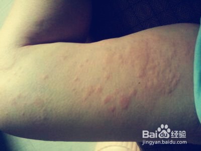 风疙瘩最快的止痒方法