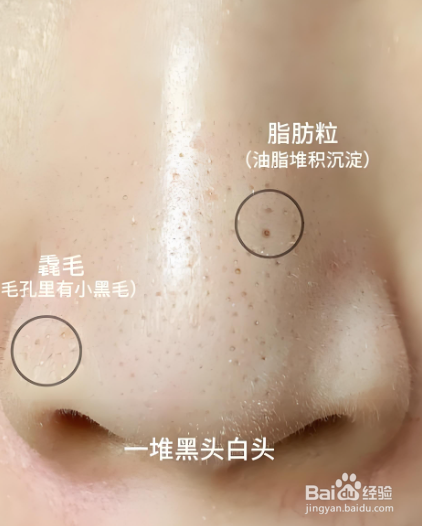 去黑头最有效的方法?