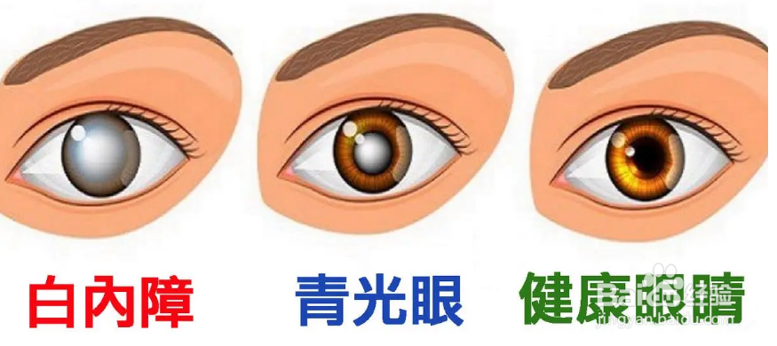 青光眼可以治愈吗？会不会失明？