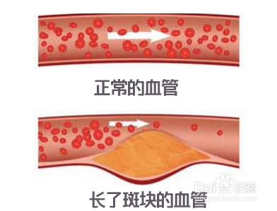 心绞痛怎样治疗	心绞痛是什么原因引起的？