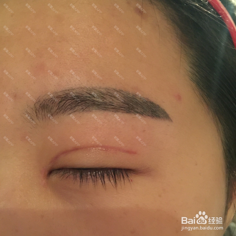 开眼角后常常无刺激下流眼泪怎么办？