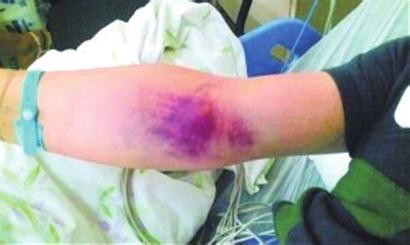 ‘’瘀血‘’是怎么回事