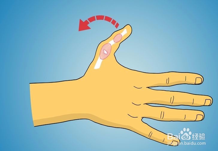 如何诊断拇指是否骨折?