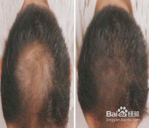 化学性脱发怎么治疗