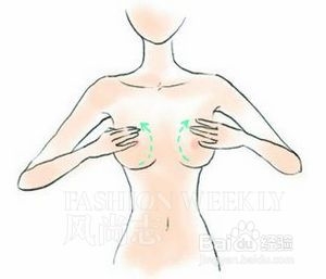丰胸胸线提升法