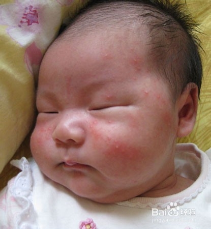 痱子和湿疹的区别