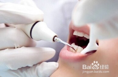 如何很快的去除牙齿上面的牙渍