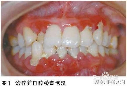 天然蜂胶的功效及食用方法