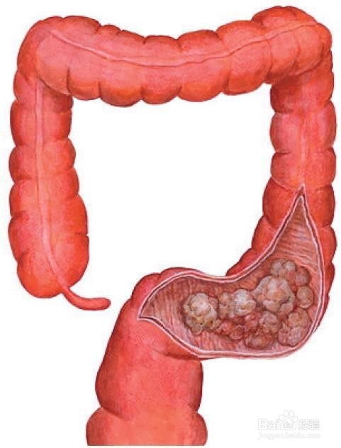【警惕】这4种腹泻是癌症的报警信号！