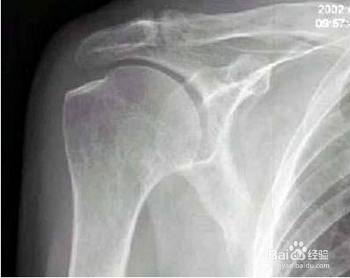 肩部酸痛是怎么回事