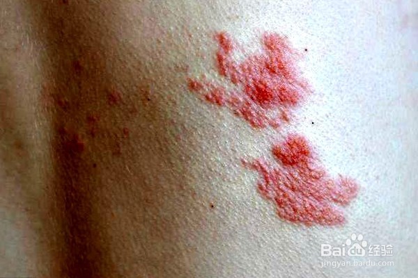 使用红外线灯可以治疗哪些疾病？