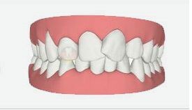 武汉牙齿矫正,需要做到“三大注意”!