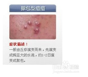 世上最全面治疗痘痘大全