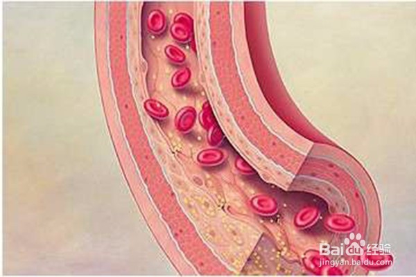 血管硬化的症状有哪些?如何预防血管硬化