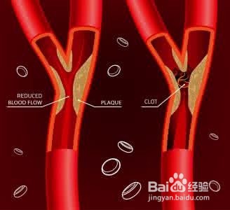 血管堵, 疾病生! 疏通血管就用这5招