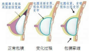 什么是包膜挛缩