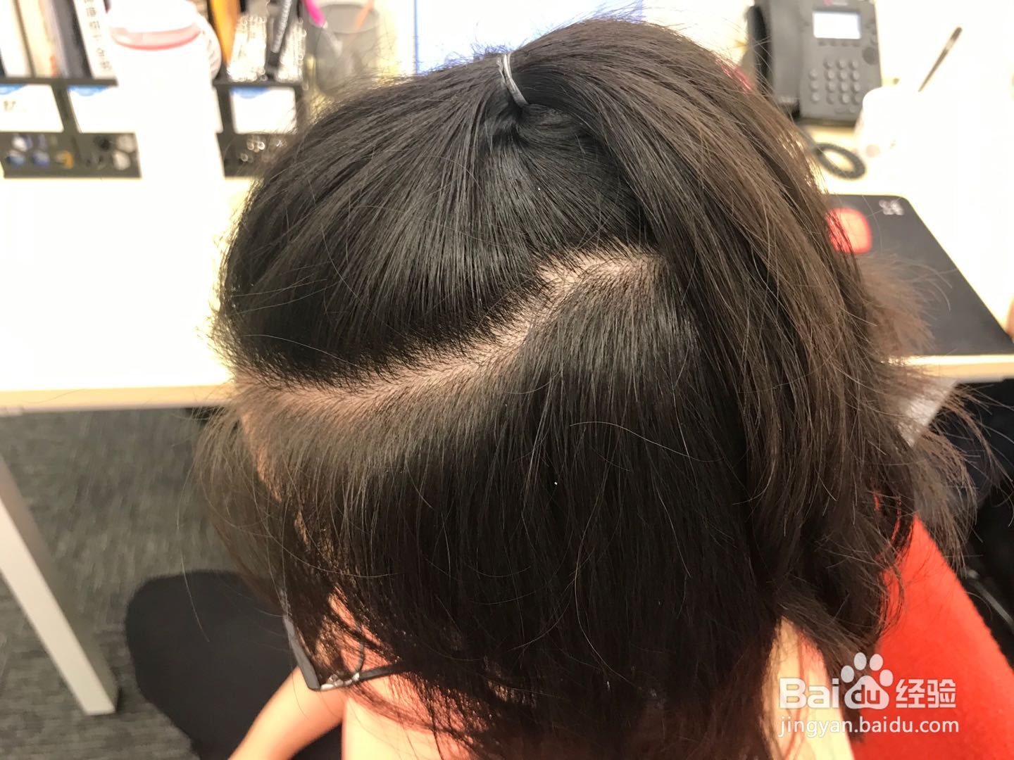 女生如何使用米诺地尔防脱生发?