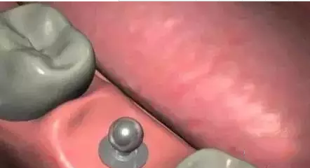 种植牙的过程是怎样的