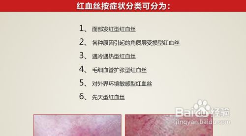 红血丝肌肤的保养方法