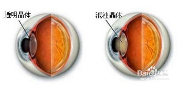 白内障患者术后应该怎么样护理