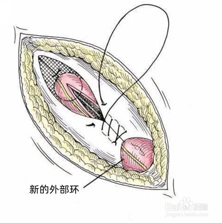 小儿疝气怎么治疗最安全
