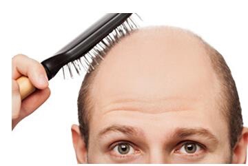 溢脂性脱发怎么治疗？