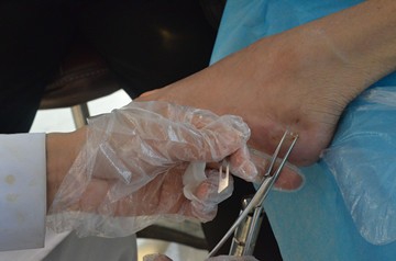 如何认知糖尿病的早期症状