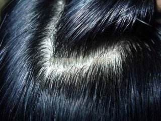 如何有效清理头皮屑防治过度复发