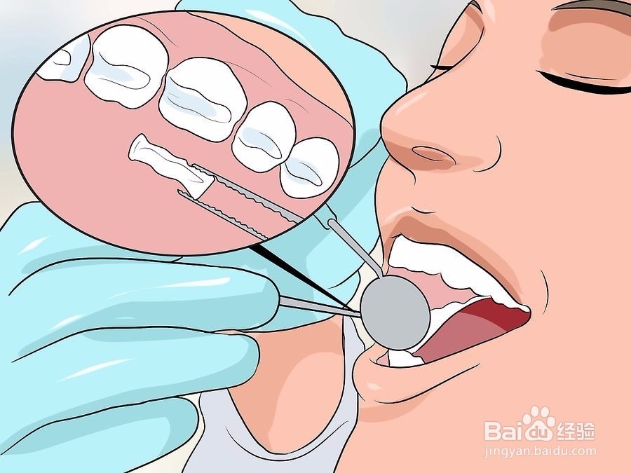 如何修复牙釉质