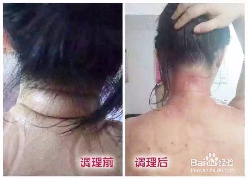 富贵包的成因、危害及其缓解预防、消除方法