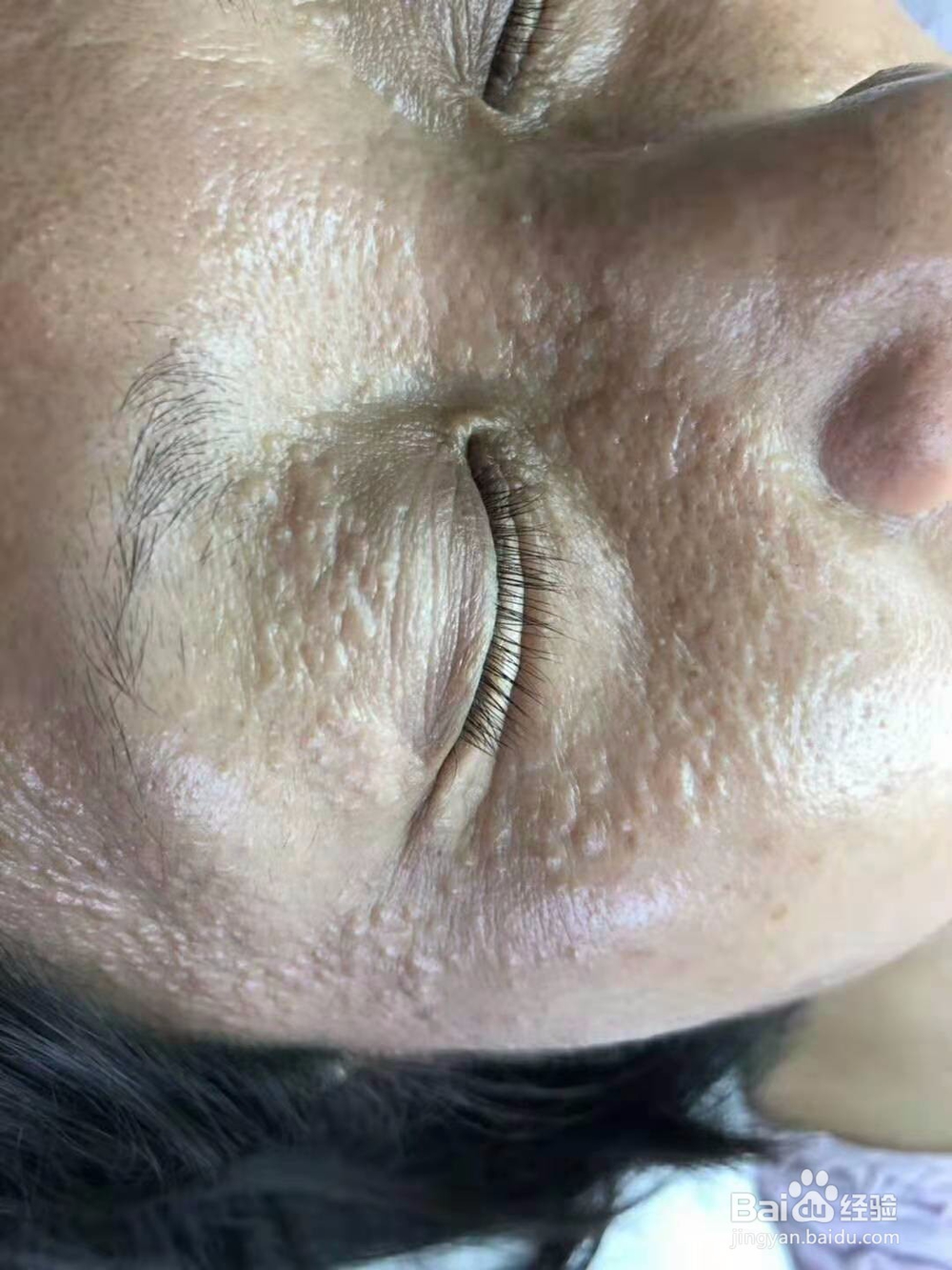 脸上长小疙瘩，可能是汗管瘤，也可能是这些疾病