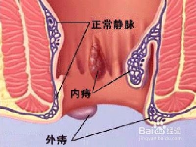 痔疮的症状有哪些