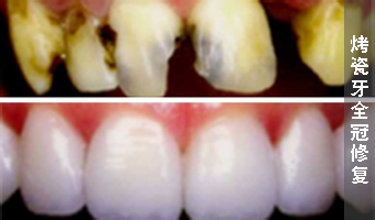 贵金属烤瓷牙优势是什么
