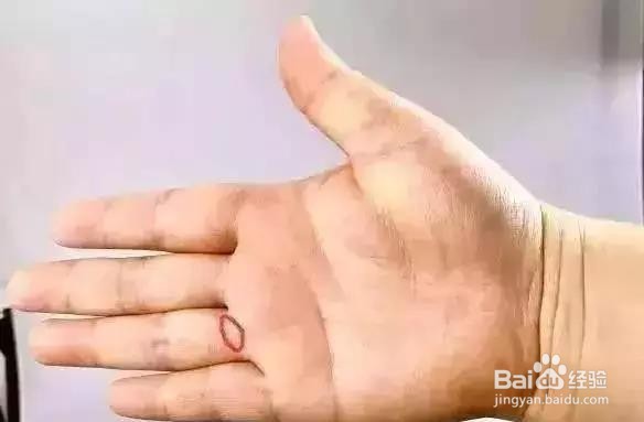 捏捏手指预防7大疾病