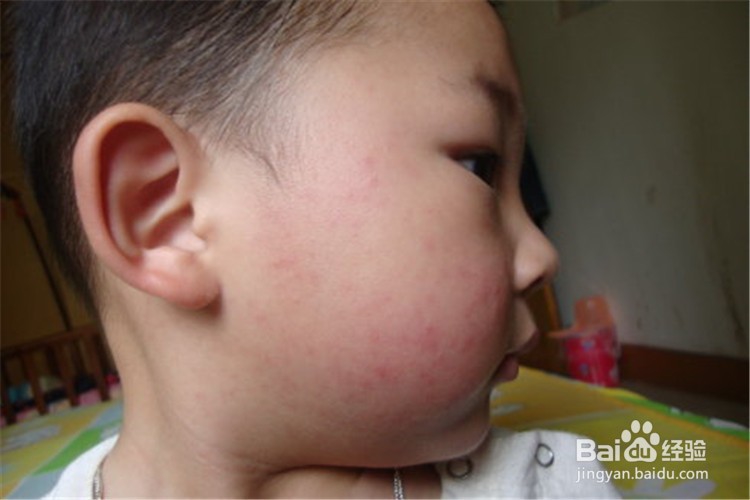 宝宝出疹子的护理和注意事项