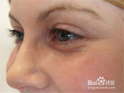 怎样消除眼角皱纹