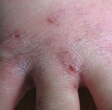 生活/家居 生活常识 疥疮的皮疹好发于皮肤薄嫩的地方,尤其是手指缝