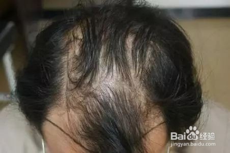 掉发的原因是那些？