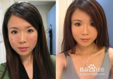 如何祛痘痘小编教你