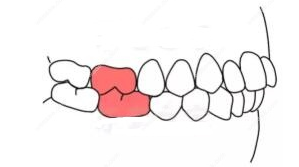 安氏一类二类三类怎样分